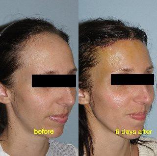 Hair Line Lowering before and after photos in San Francisco, CA, Patient 15166