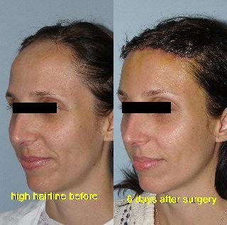 Hair Line Lowering before and after photos in San Francisco, CA, Patient 15166