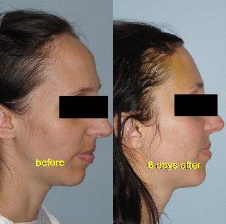 Hair Line Lowering before and after photos in San Francisco, CA, Patient 15166