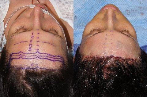 Hair Line Lowering before and after photos in San Francisco, CA, Patient 15166