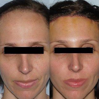Hair Line Lowering before and after photos in San Francisco, CA, Patient 15166