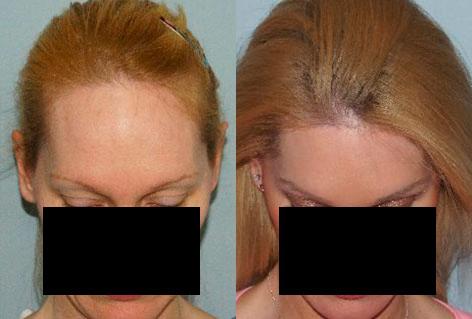 Hair Line Lowering before and after photos in San Francisco, CA, Patient 15377