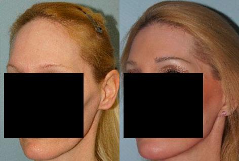 Hair Line Lowering before and after photos in San Francisco, CA, Patient 15377