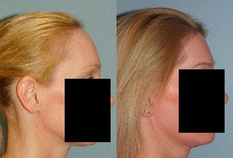 Hair Line Lowering before and after photos in San Francisco, CA, Patient 15377