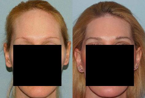 Hair Line Lowering before and after photos in San Francisco, CA, Patient 15377