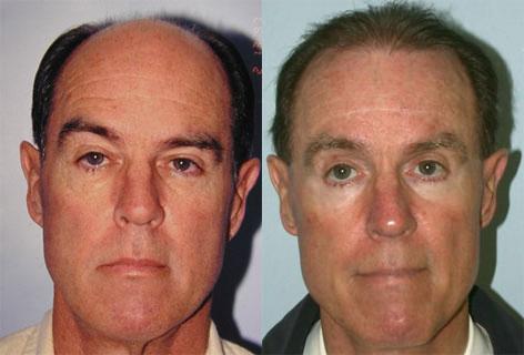 Blepharoplasty before and after photos in San Francisco, CA, Patient 13036