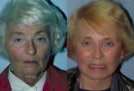 Blepharoplasty before and after photos in San Francisco, CA, Patient 13055