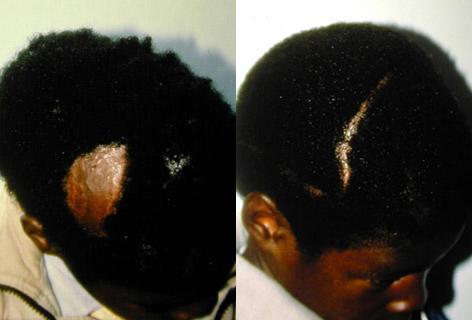 Hair Reconstructive Scalp before and after photos in San Francisco, CA, Patient 13839