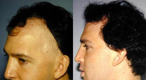 Hair Reconstructive Scalp before and after photos in San Francisco, CA, Patient 13842