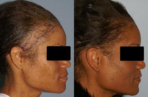 Hair Reconstructive Scalp before and after photos in San Francisco, CA, Patient 13862