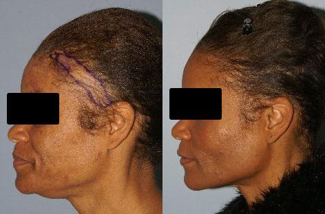 Hair Reconstructive Scalp before and after photos in San Francisco, CA, Patient 13862