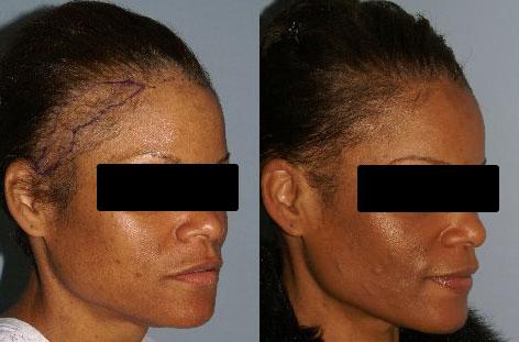 Hair Reconstructive Scalp before and after photos in San Francisco, CA, Patient 13862