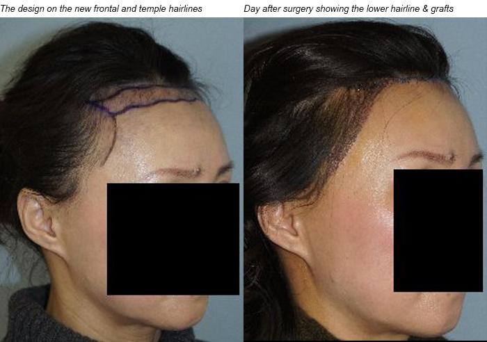 Hair Line Lowering before and after photos in San Francisco, CA, Patient 14325