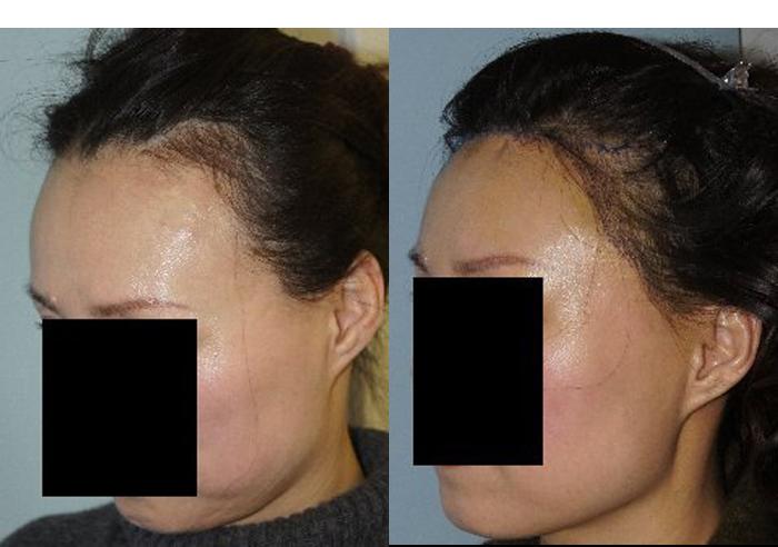 Hair Line Lowering before and after photos in San Francisco, CA, Patient 14325