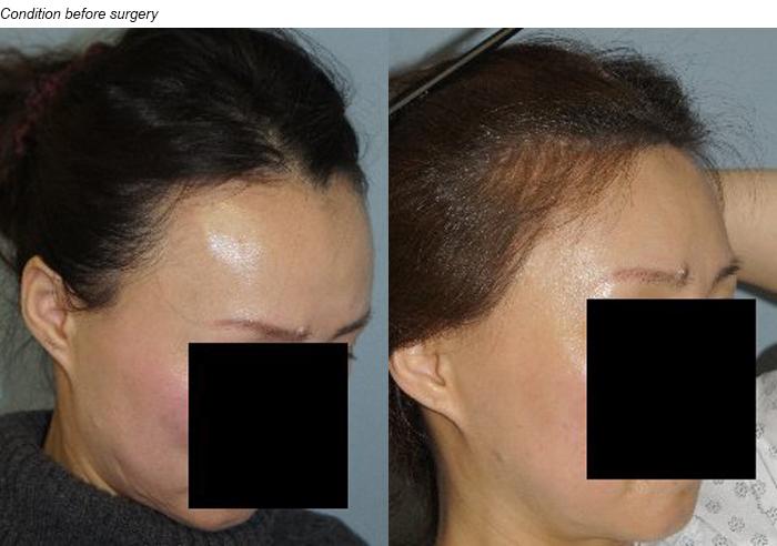 Hair Line Lowering before and after photos in San Francisco, CA, Patient 14325