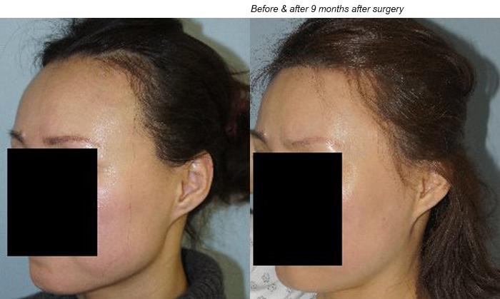 Hair Line Lowering before and after photos in San Francisco, CA, Patient 14325