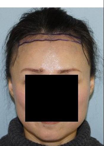 Hair Line Lowering before and after photos in San Francisco, CA, Patient 14325