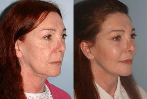 Facelift before and after photos in San Francisco, CA, Patient 14420