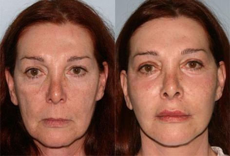 Facelift before and after photos in San Francisco, CA, Patient 14420