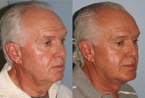 Facelift before and after photos in San Francisco, CA, Patient 14707