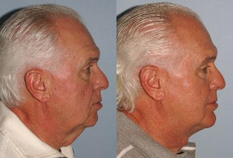 Facelift before and after photos in San Francisco, CA, Patient 14707