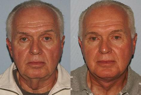 Facelift before and after photos in San Francisco, CA, Patient 14707