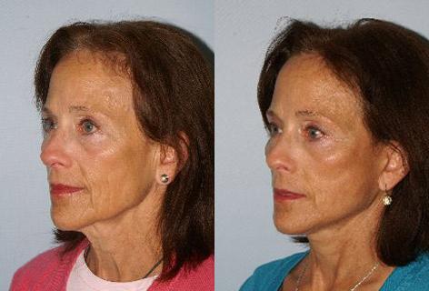Facelift before and after photos in San Francisco, CA, Patient 14718