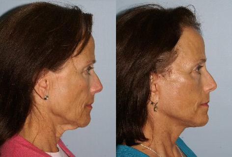 Facelift before and after photos in San Francisco, CA, Patient 14718