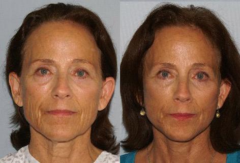 Facelift before and after photos in San Francisco, CA, Patient 14718