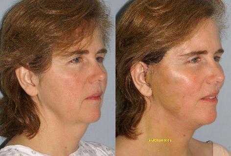 Facelift before and after photos in San Francisco, CA, Patient 14983