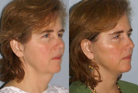 Facelift before and after photos in San Francisco, CA, Patient 14983