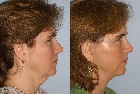 Facelift before and after photos in San Francisco, CA, Patient 14983