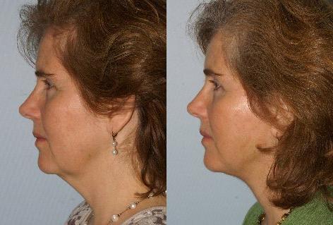 Facelift before and after photos in San Francisco, CA, Patient 14983