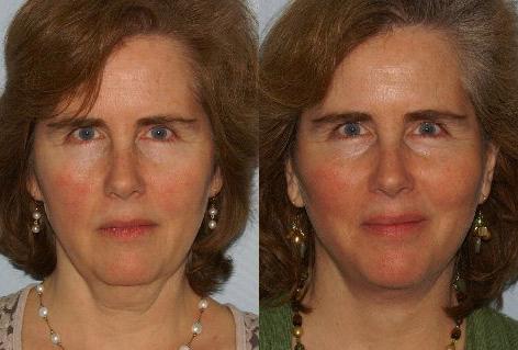 Facelift before and after photos in San Francisco, CA, Facelift in San Francisco, CA