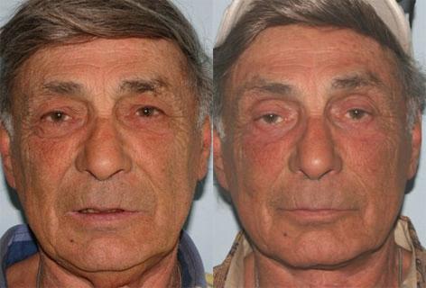 Facelift before and after photos in San Francisco, CA, Patient 15065