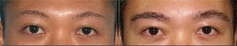 Browlift before and after photos in San Francisco, CA, Patient 13085