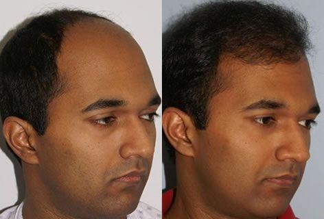 Follicular Unit Hair Grafting before and after photos in San Francisco, CA, Patient 13740