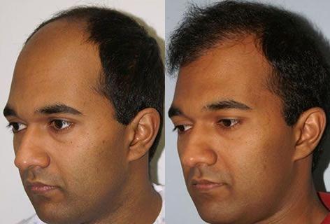 Follicular Unit Hair Grafting before and after photos in San Francisco, CA, Patient 13740