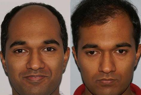 Follicular Unit Hair Grafting before and after photos in San Francisco, CA, Patient 13740