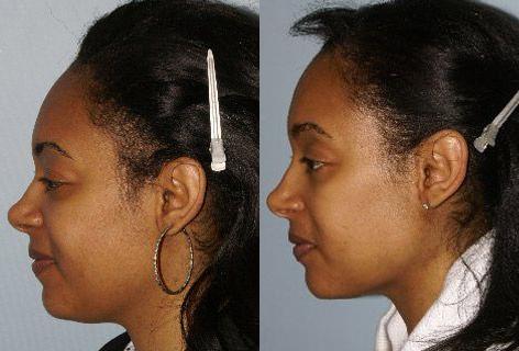 Follicular Unit Hair Grafting before and after photos in San Francisco, CA, Patient 13790