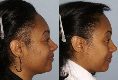 Follicular Unit Hair Grafting before and after photos in San Francisco, CA, Patient 13790