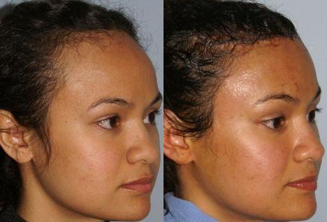 Hair Line Lowering before and after photos in San Francisco, CA, Patient 13956