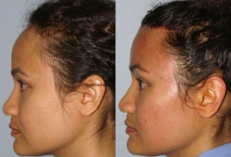 Hair Line Lowering before and after photos in San Francisco, CA, Patient 13956