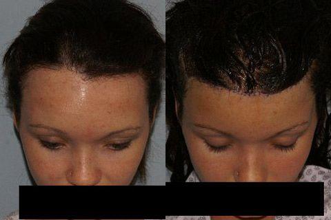 Hair Line Lowering before and after photos in San Francisco, CA, Patient 14219