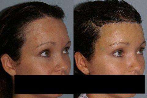 Hair Line Lowering before and after photos in San Francisco, CA, Patient 14219