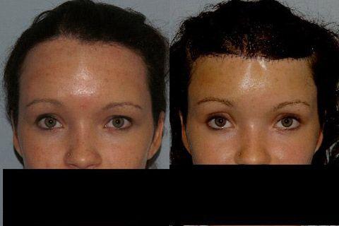 Hair Line Lowering before and after photos in San Francisco, CA, Patient 14219