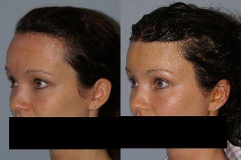 Hair Line Lowering before and after photos in San Francisco, CA, Patient 14219