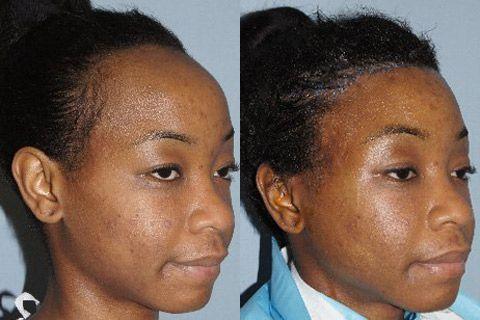 Hair Line Lowering before and after photos in San Francisco, CA, Patient 14233