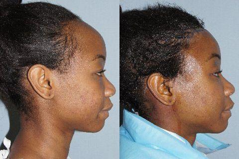 Hair Line Lowering before and after photos in San Francisco, CA, Patient 14233