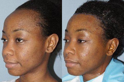 Hair Line Lowering before and after photos in San Francisco, CA, Patient 14233